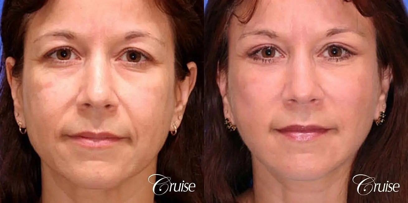 Face Lift Before & After
