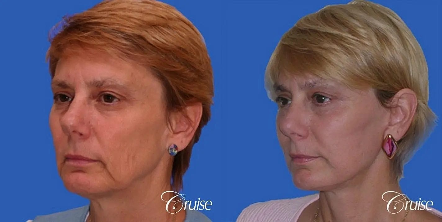 Face Lift Before & After