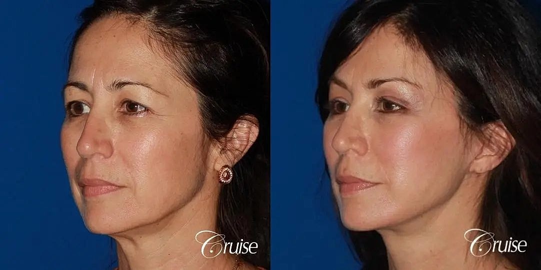 Face Lift Before & After