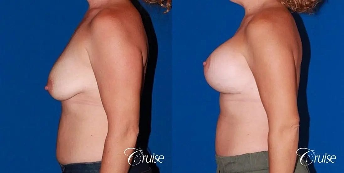 Breast Lift Augmentation Before & After