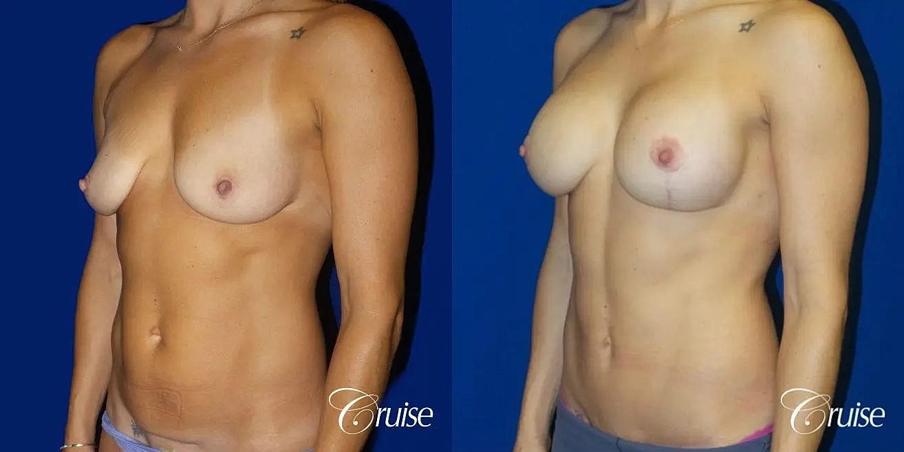 Breast Lift Augmentation Before & After
