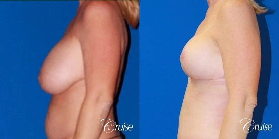 Breast Lift Augmentation Before & After