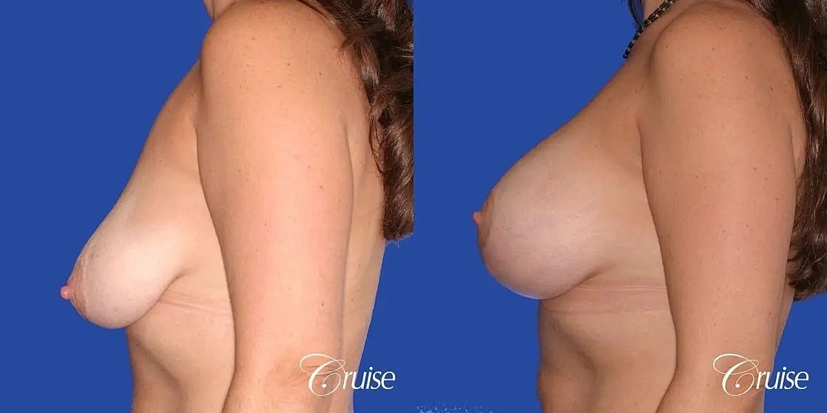 Breast Lift Augmentation Before & After