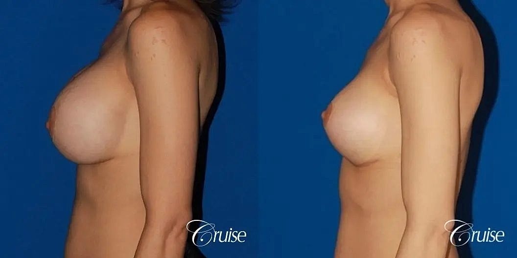 Breast Lift Augmentation Before & After