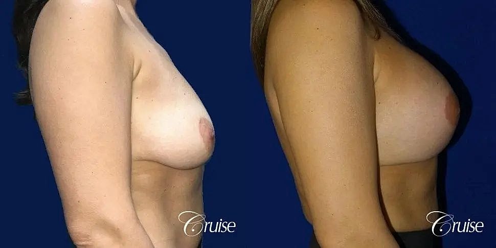 Breast Lift Augmentation Before & After