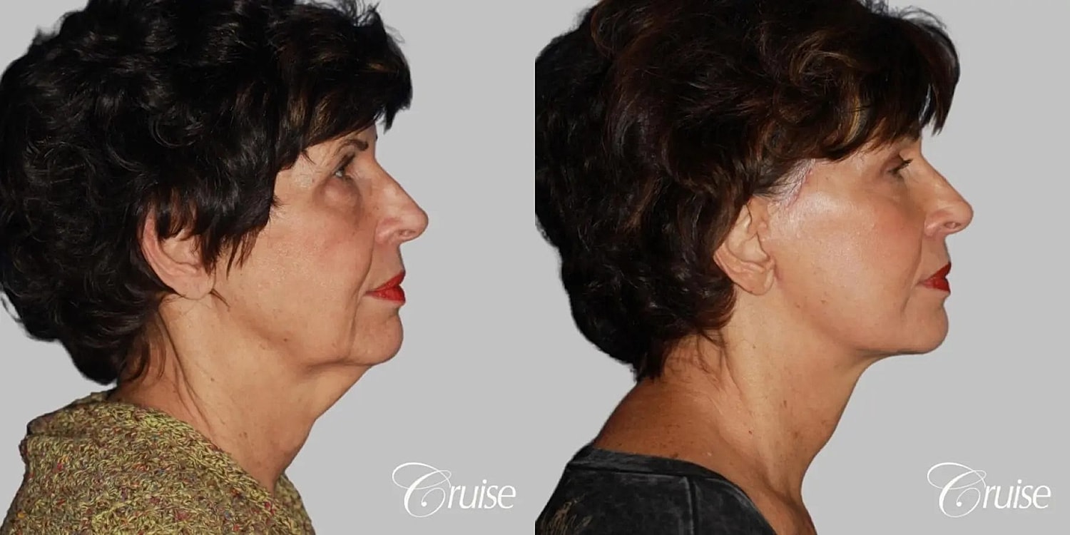 Neck Lift Before & After