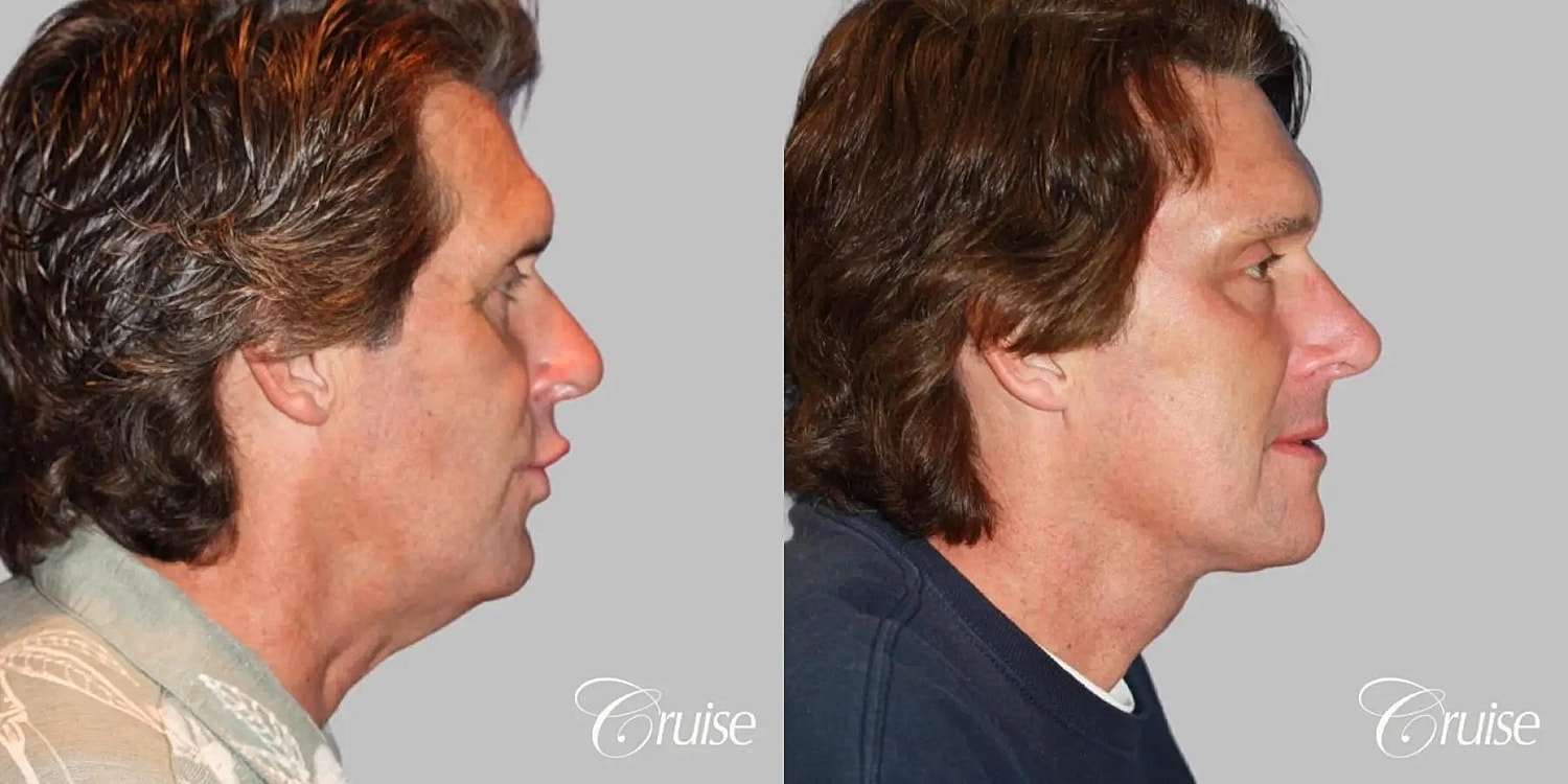 Neck Lift Before & After