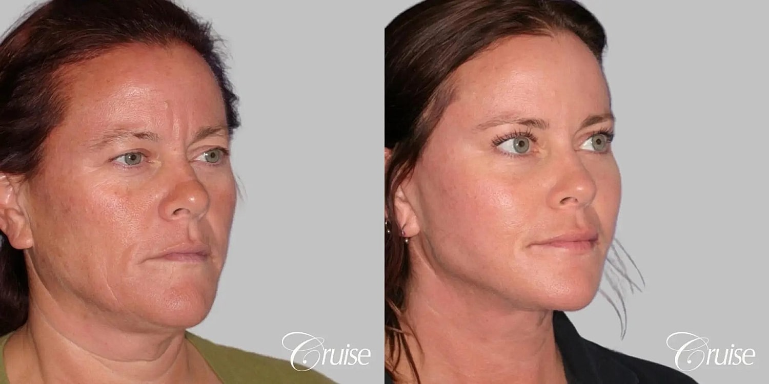 Neck Lift Before & After