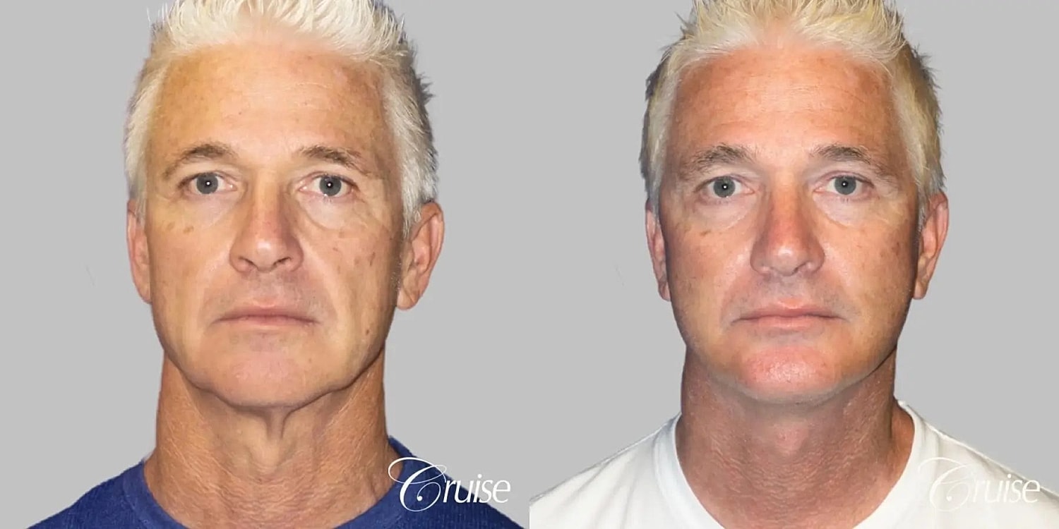 Neck Lift Before & After