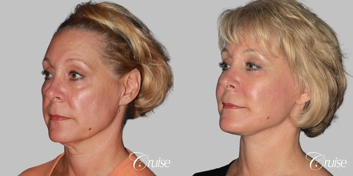 Neck Lift Before & After