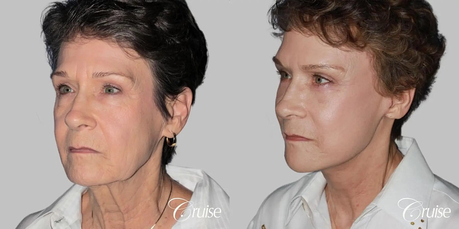 Neck Lift Before & After