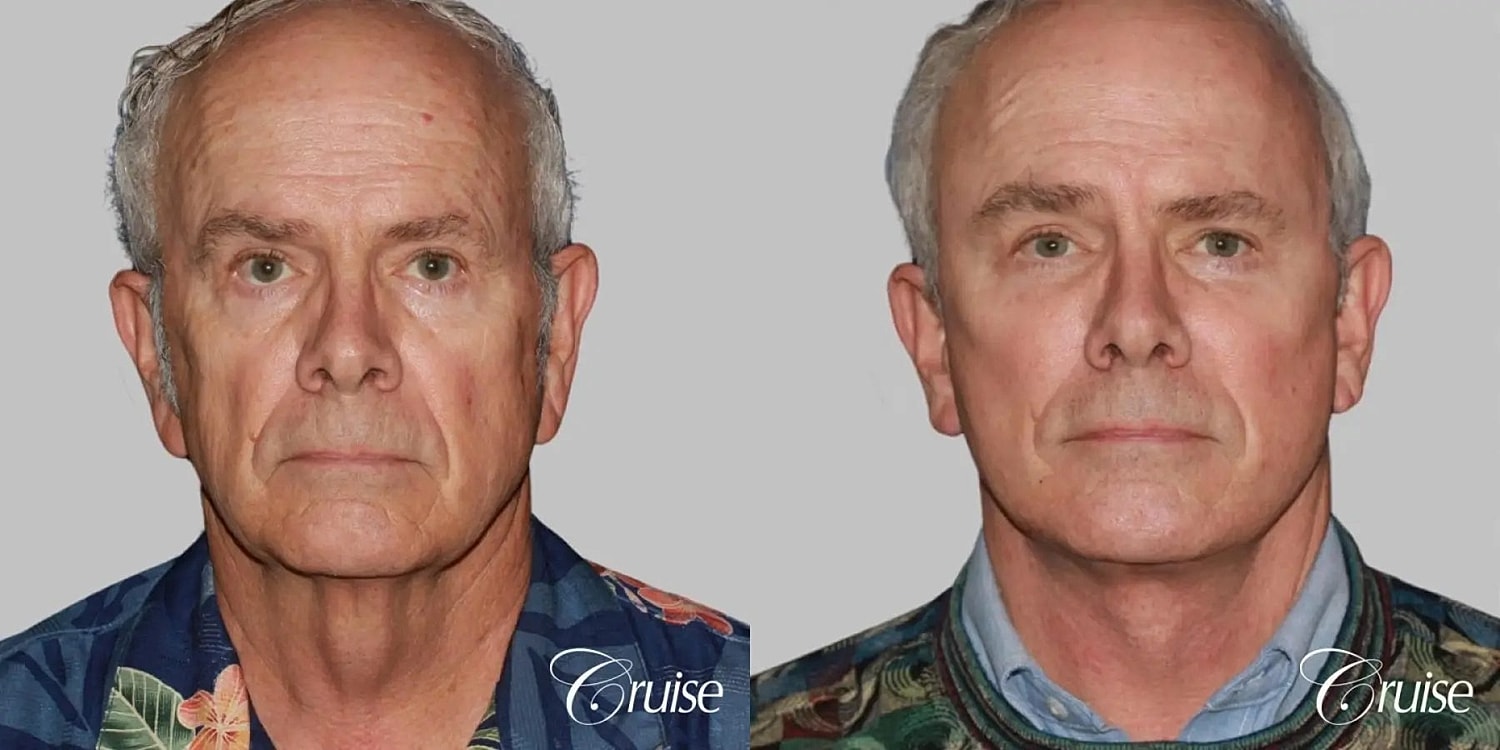 Neck Lift Before & After