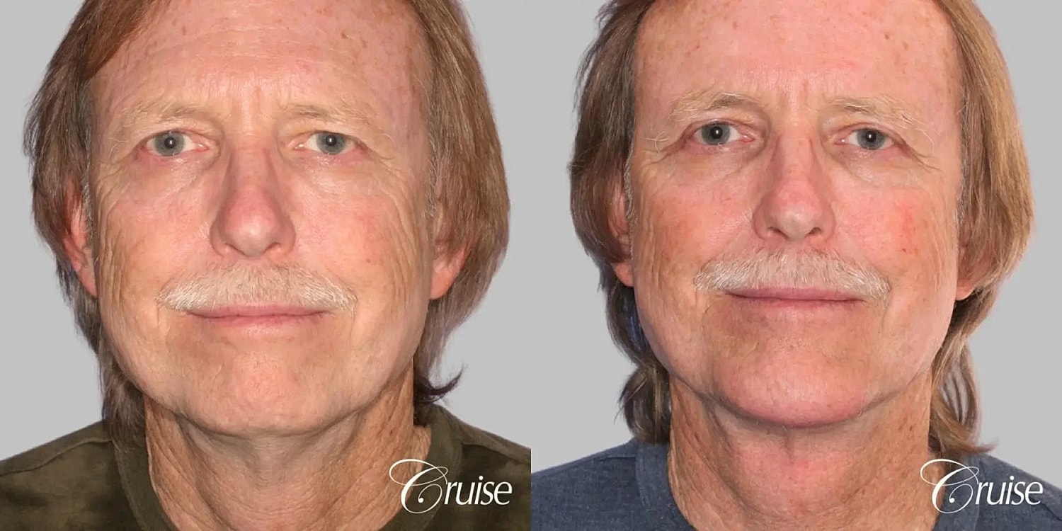 Neck Lift Before & After