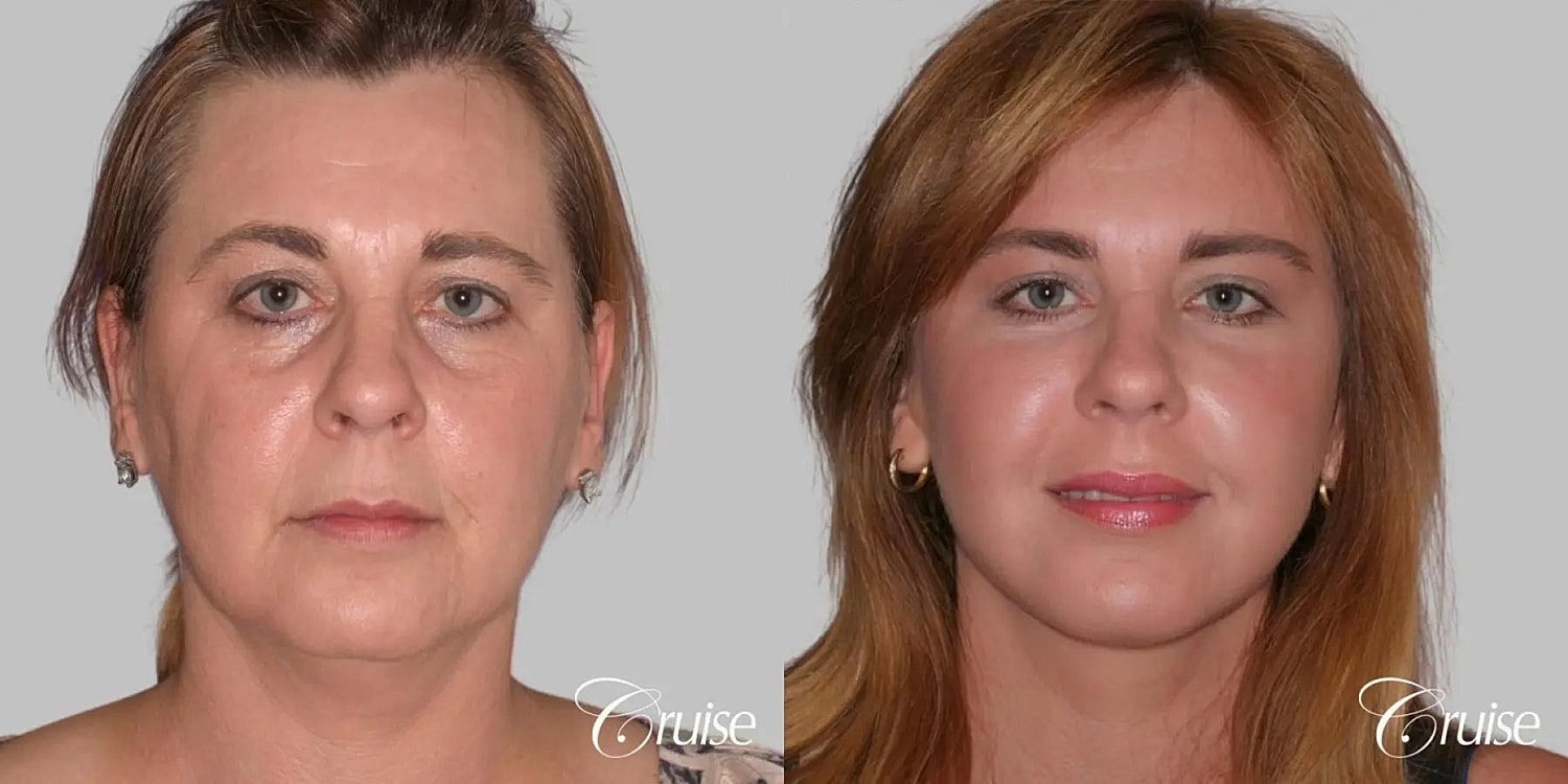 Neck Lift Before & After
