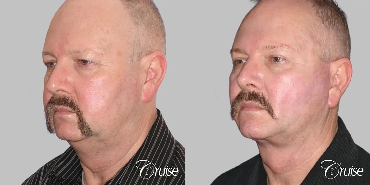 Neck Lift Before & After