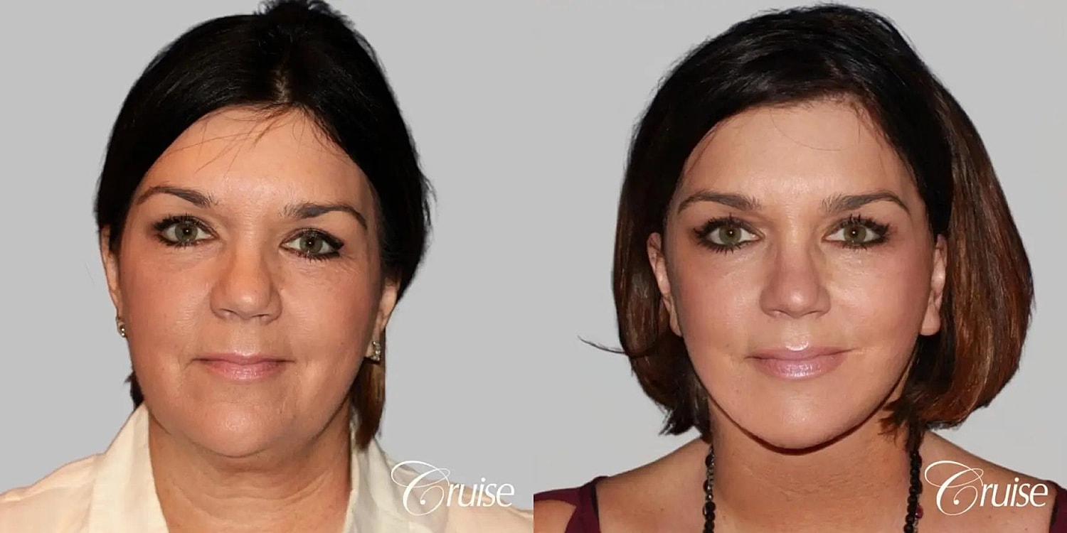 Neck Lift Before & After