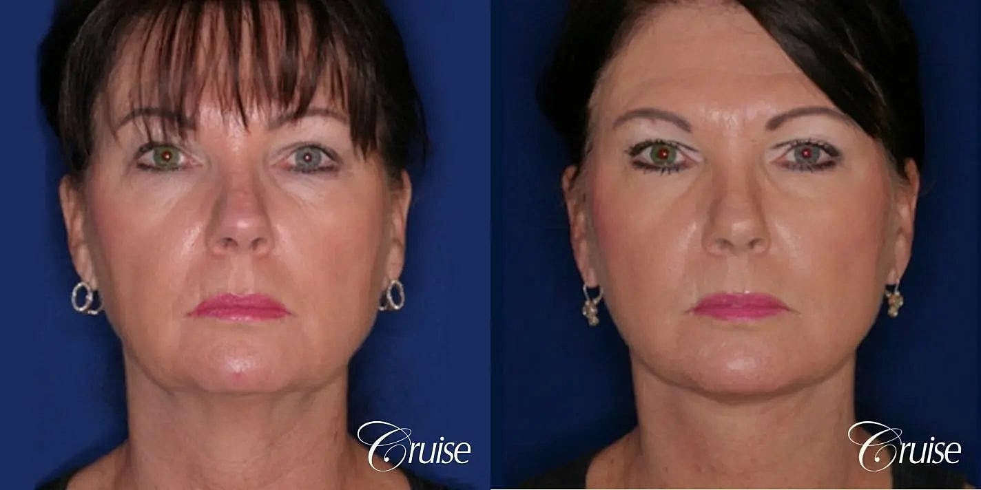 Neck Lift Before & After