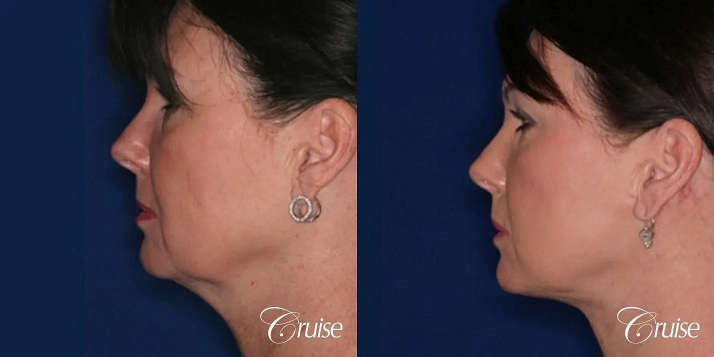 Neck Lift Before & After
