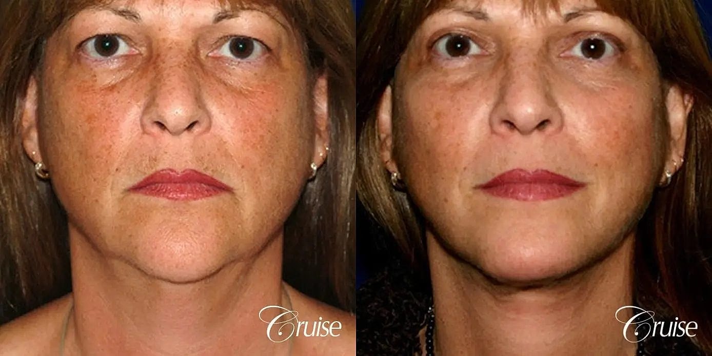 Neck Lift Before & After