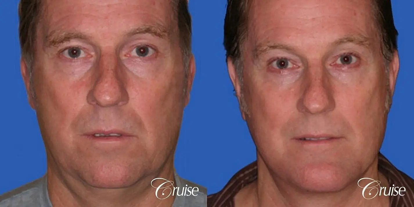 Neck Lift Before & After