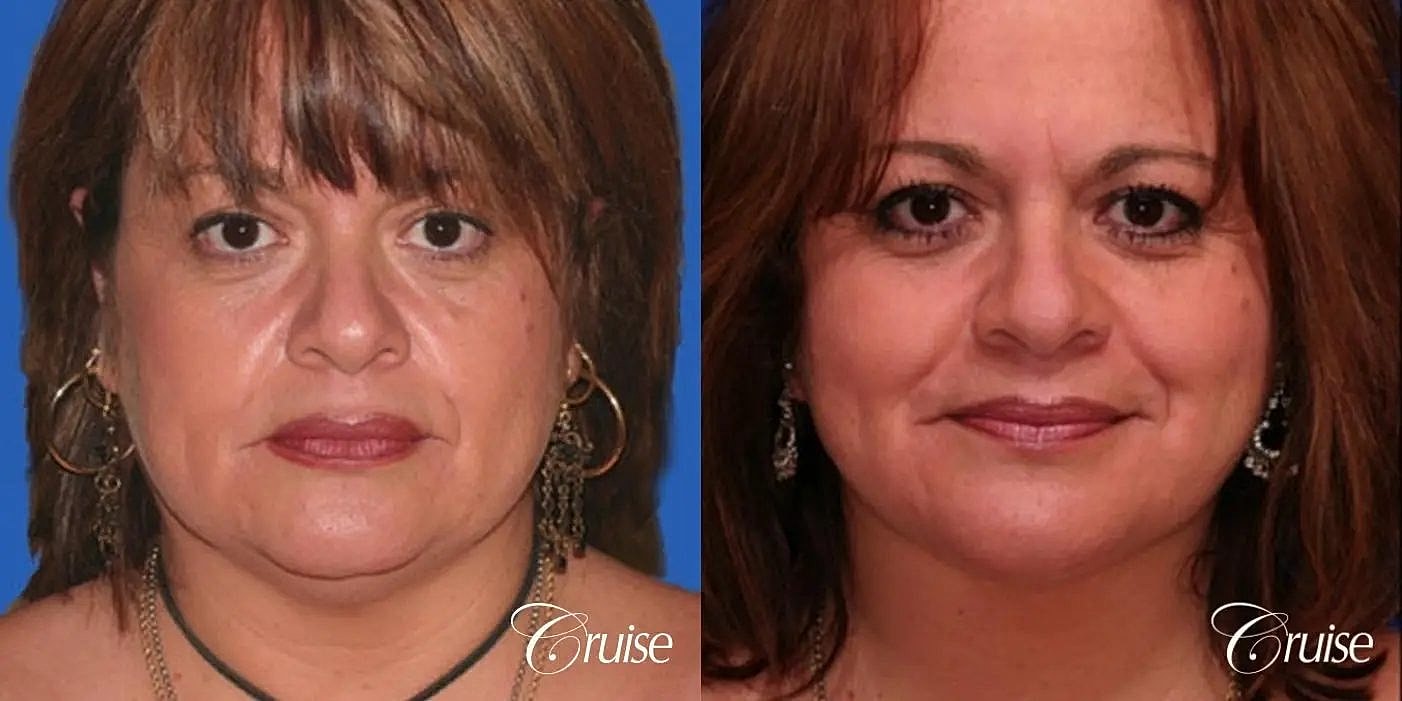 Neck Lift Before & After