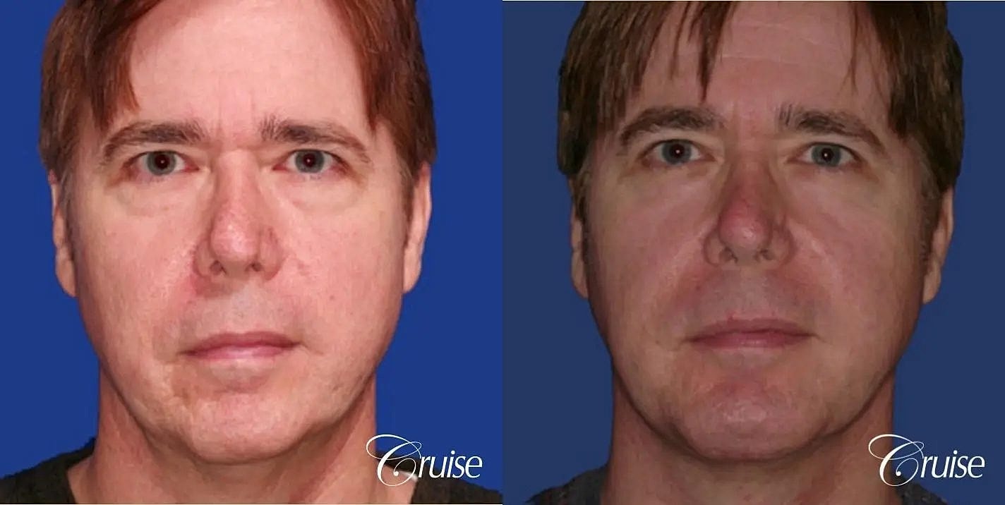 Neck Lift Before & After
