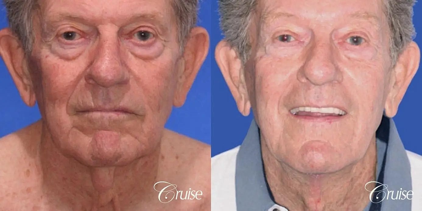 Neck Lift Before & After