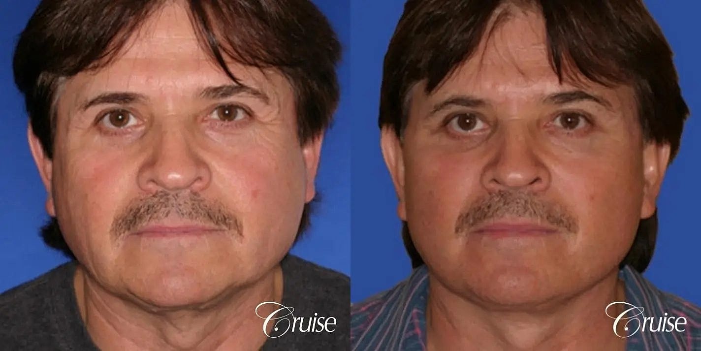 Neck Lift Before & After