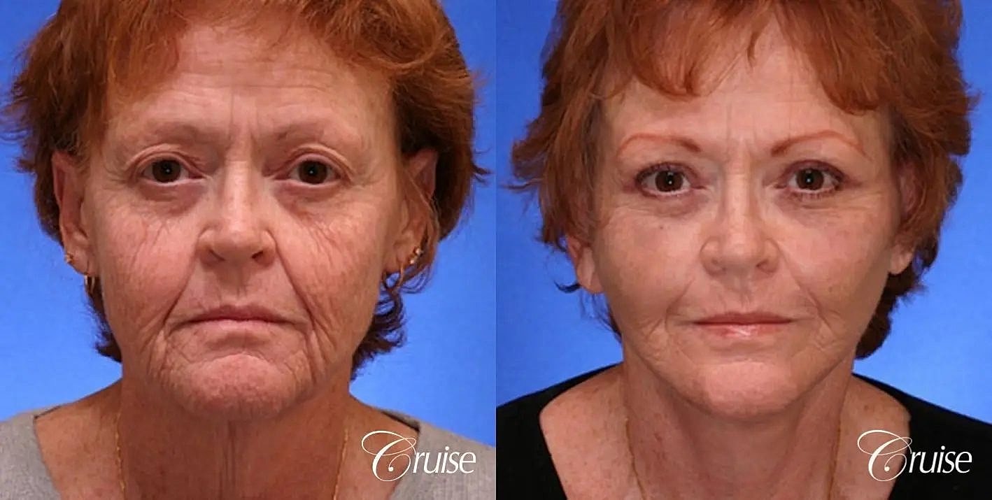Neck Lift Before & After