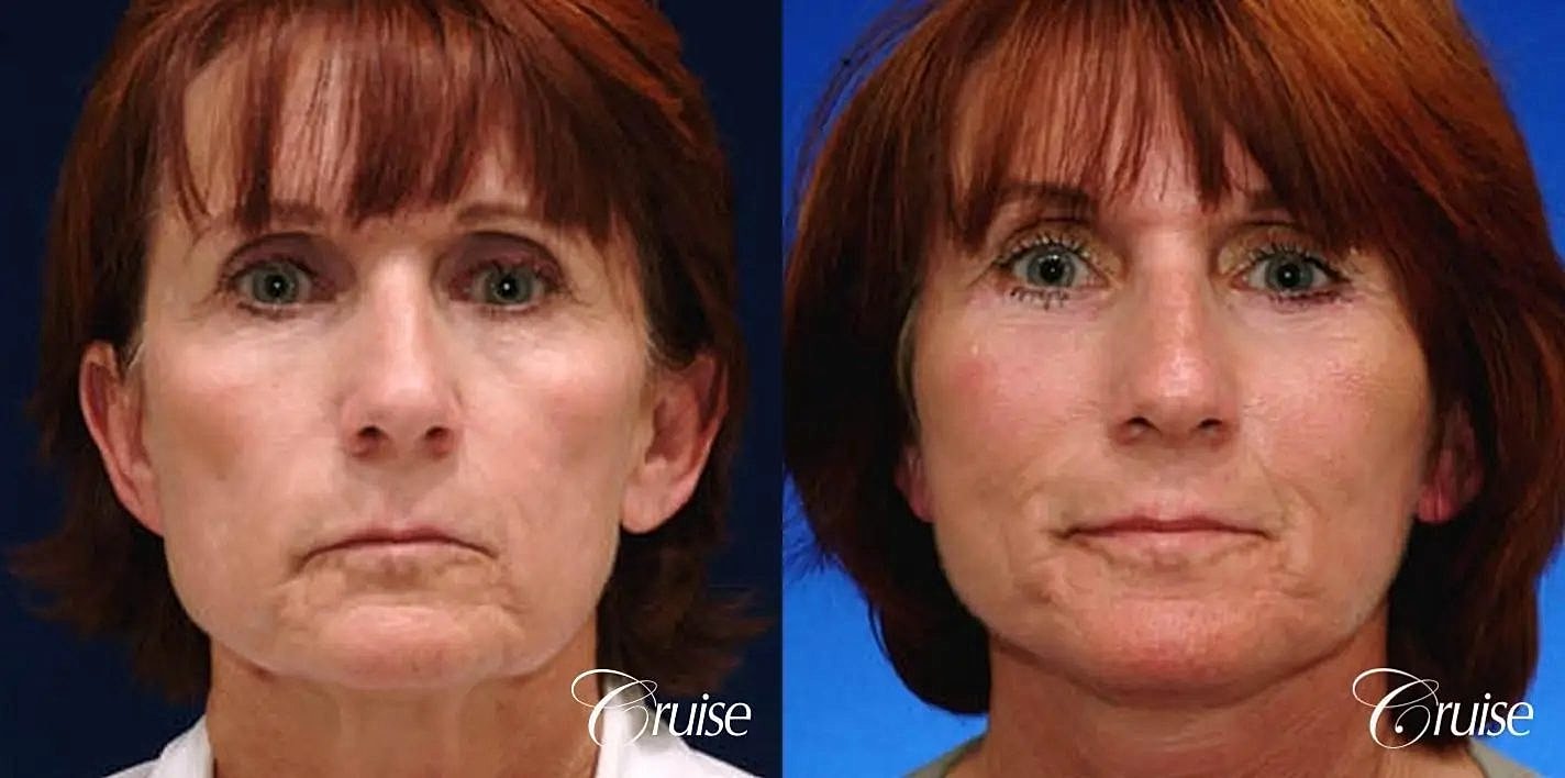 Neck Lift Before & After