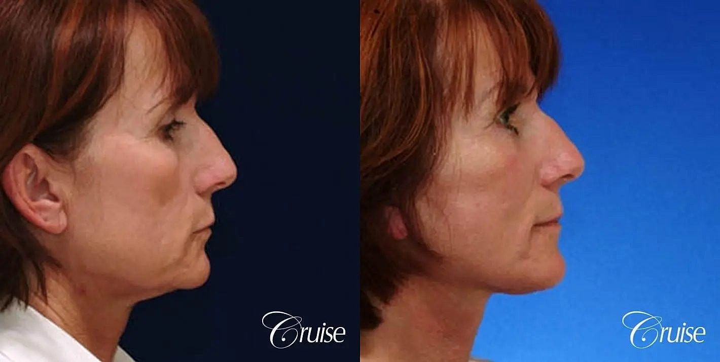 Neck Lift Before & After
