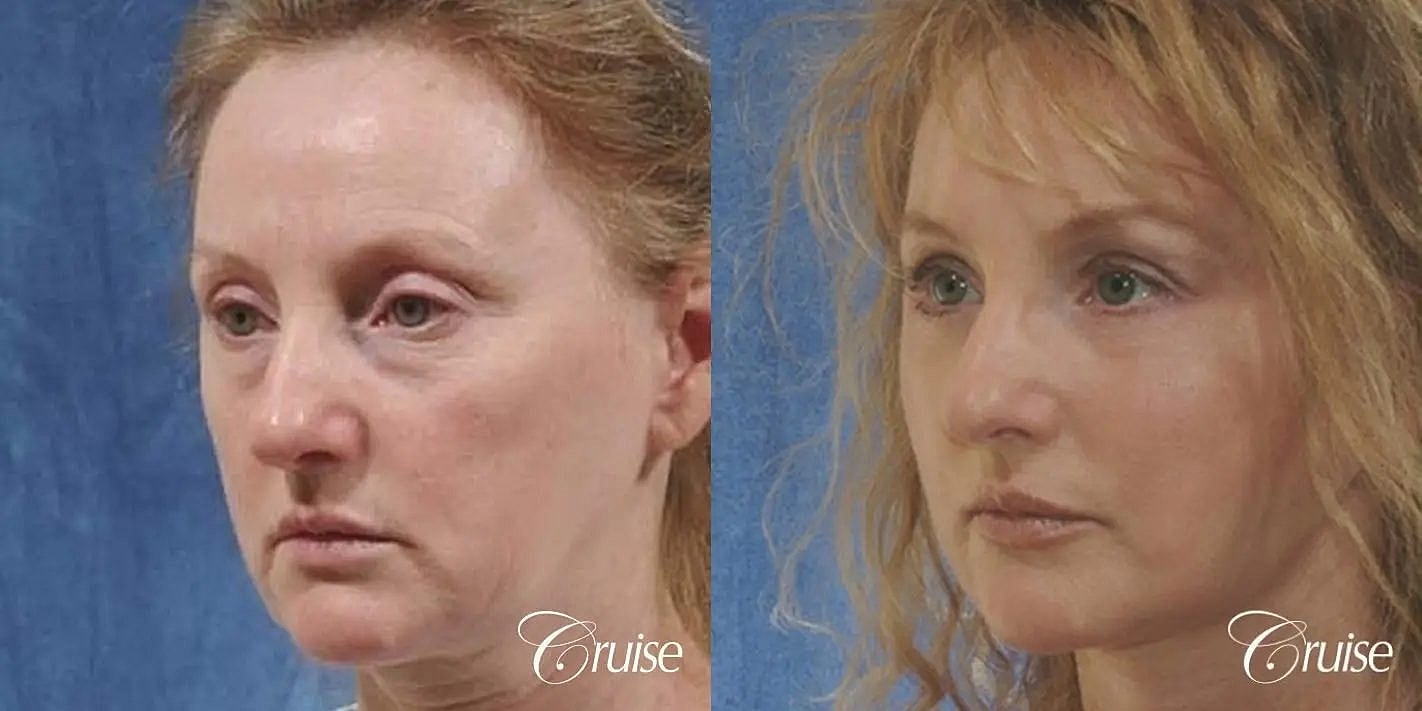 Neck Lift Before & After