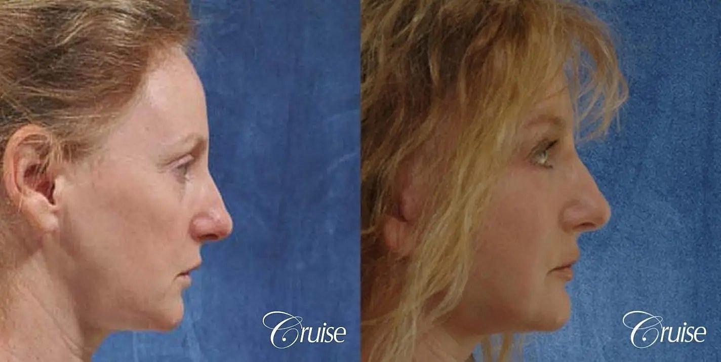 Neck Lift Before & After