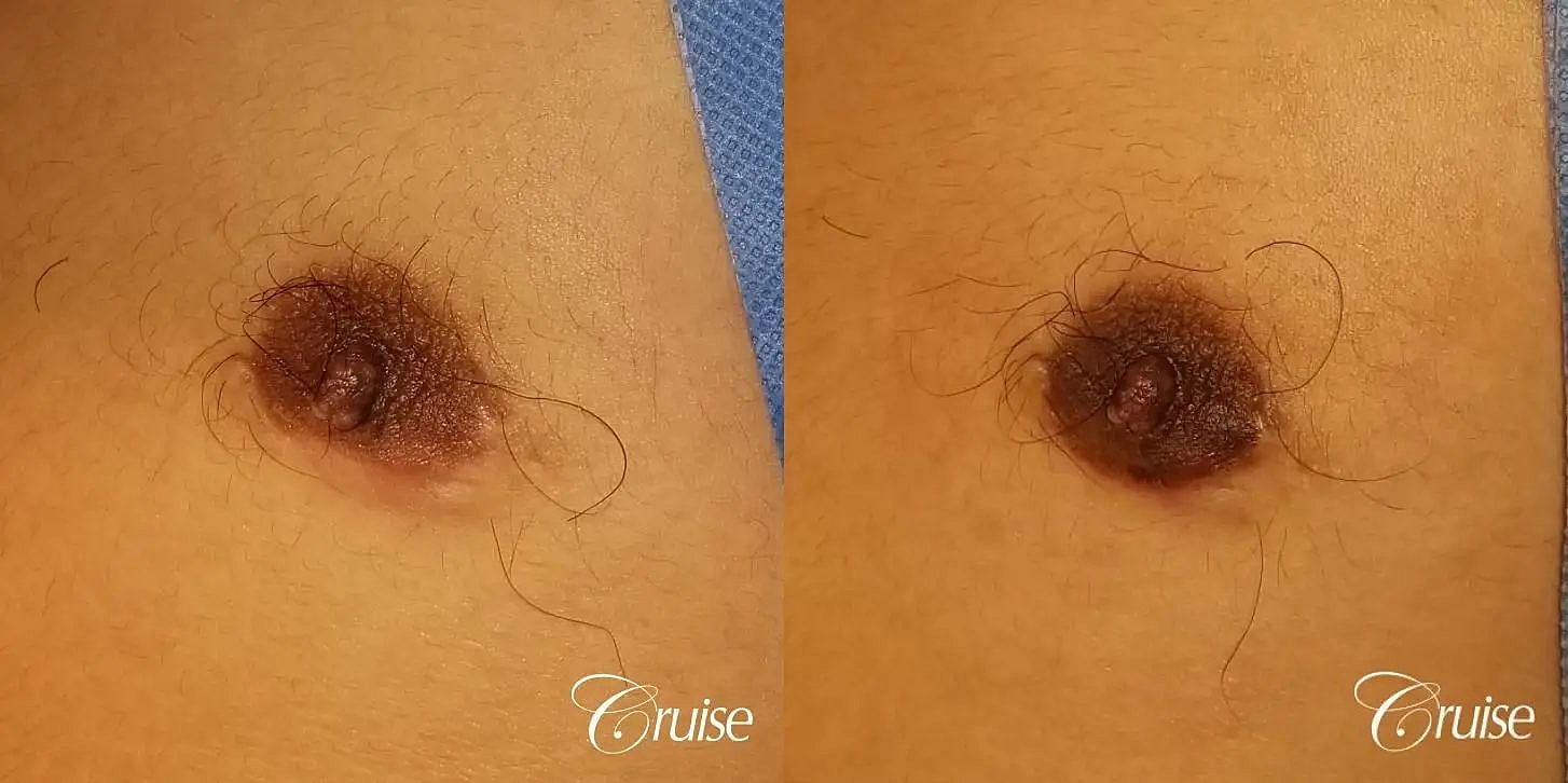 Medical Tattooing Before & After