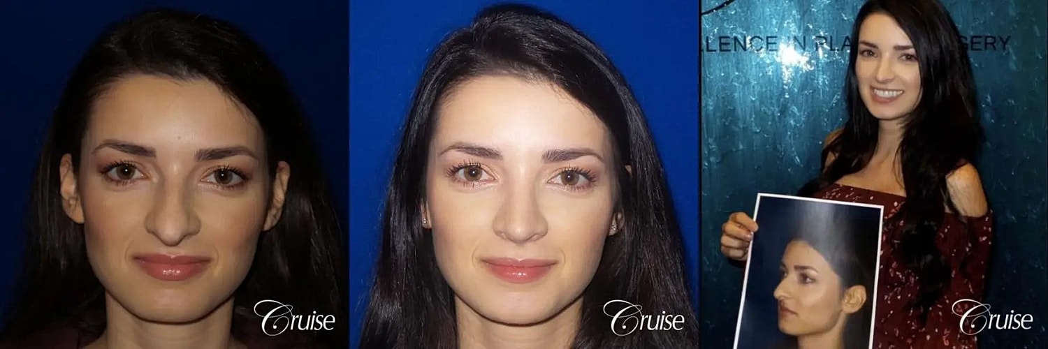 Rhinoplasty Before & After