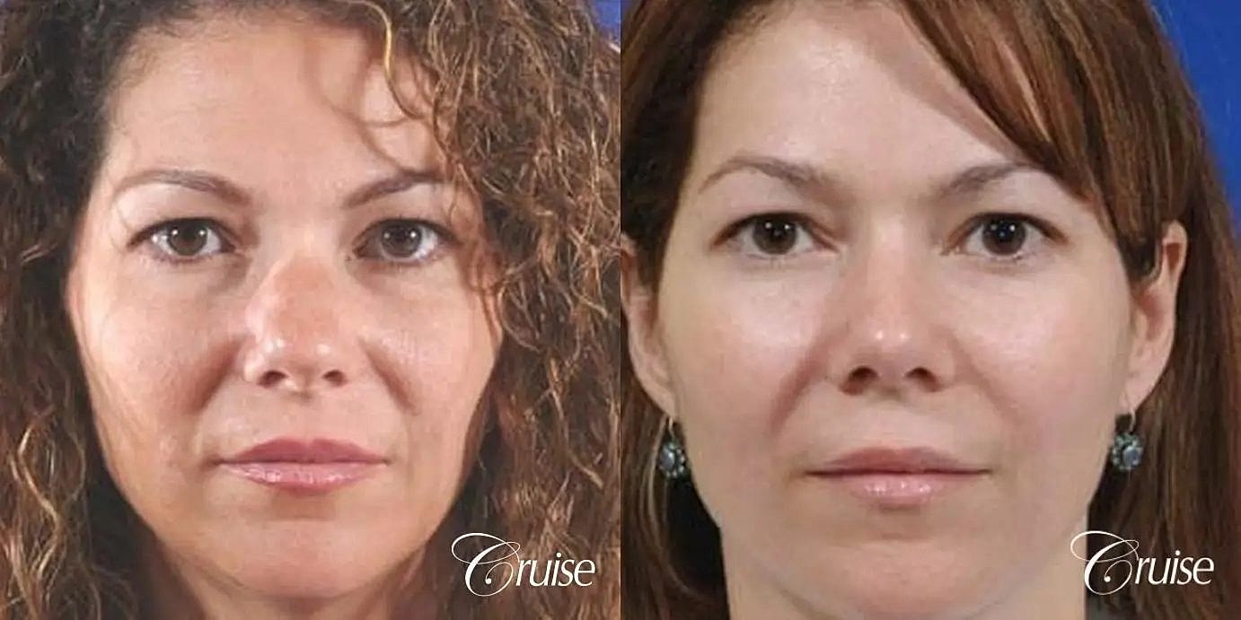 Rhinoplasty Before & After