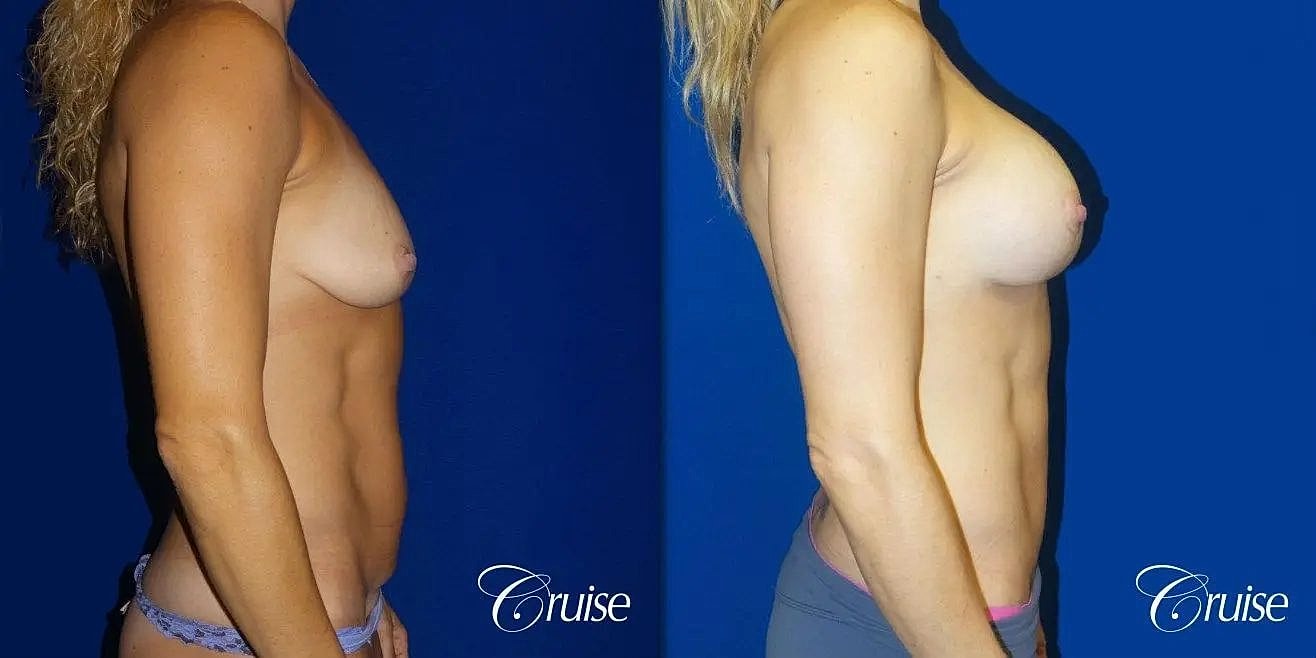 Mommy Makeover Before & After
