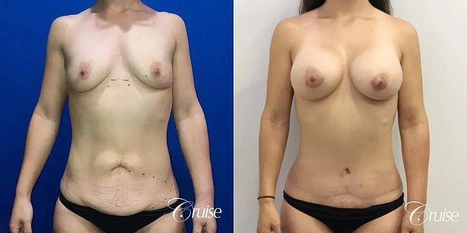 Mommy Makeover Before & After