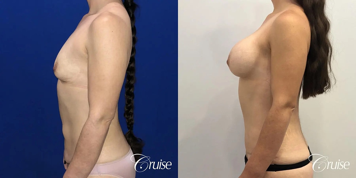 Mommy Makeover Before & After
