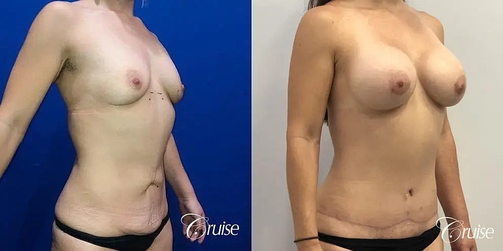 Mommy Makeover Before & After