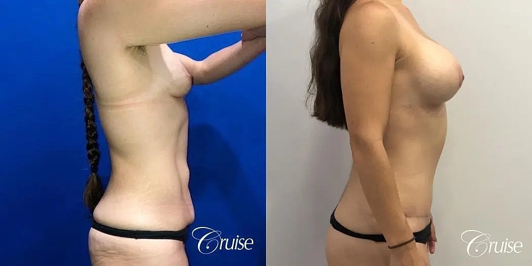 Mommy Makeover Before & After