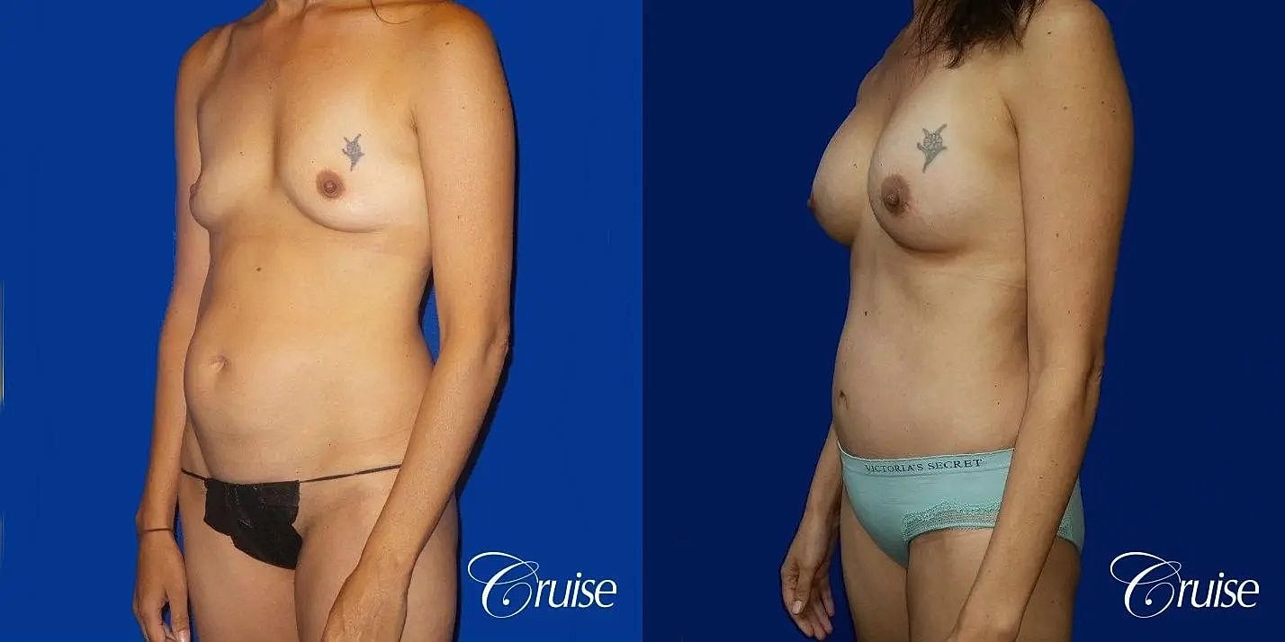 Mommy Makeover Before & After