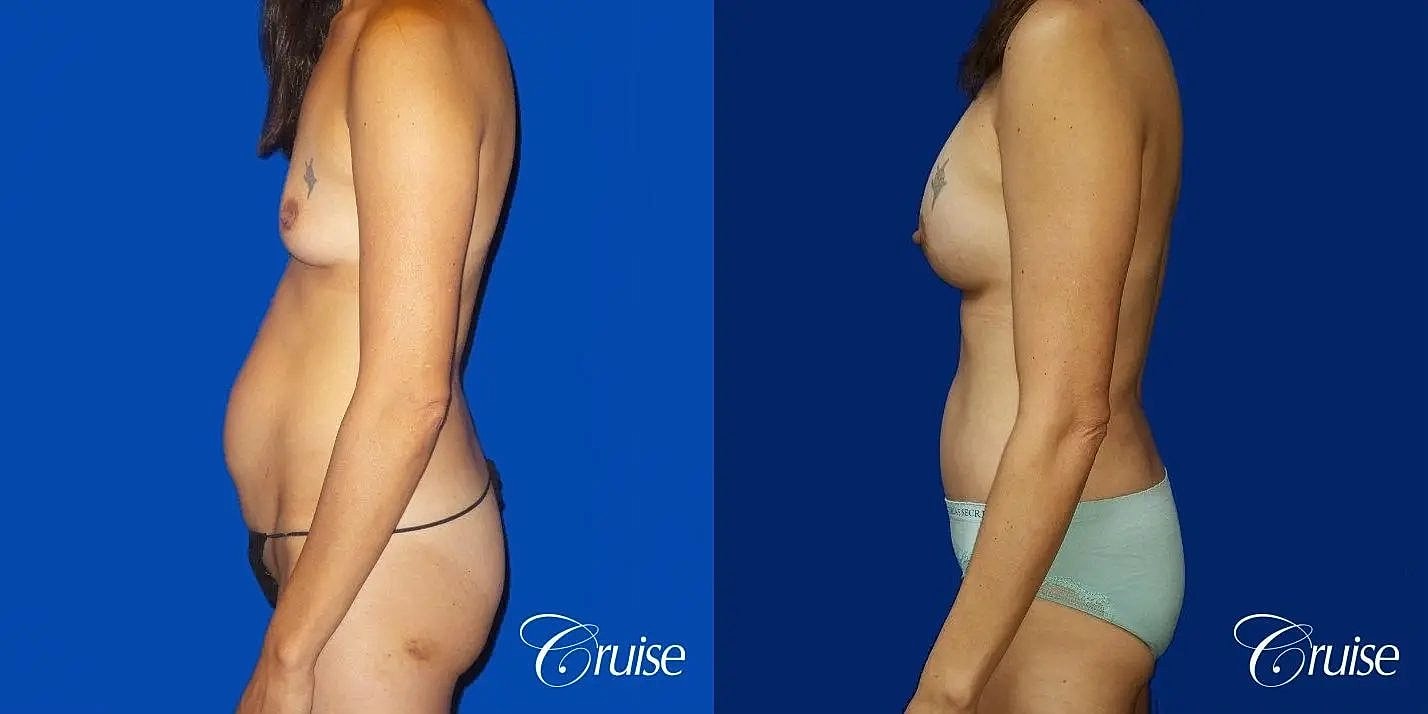 Mommy Makeover Before & After