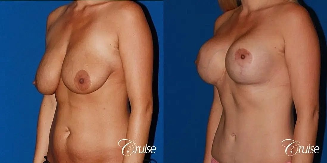 Mommy Makeover Before & After