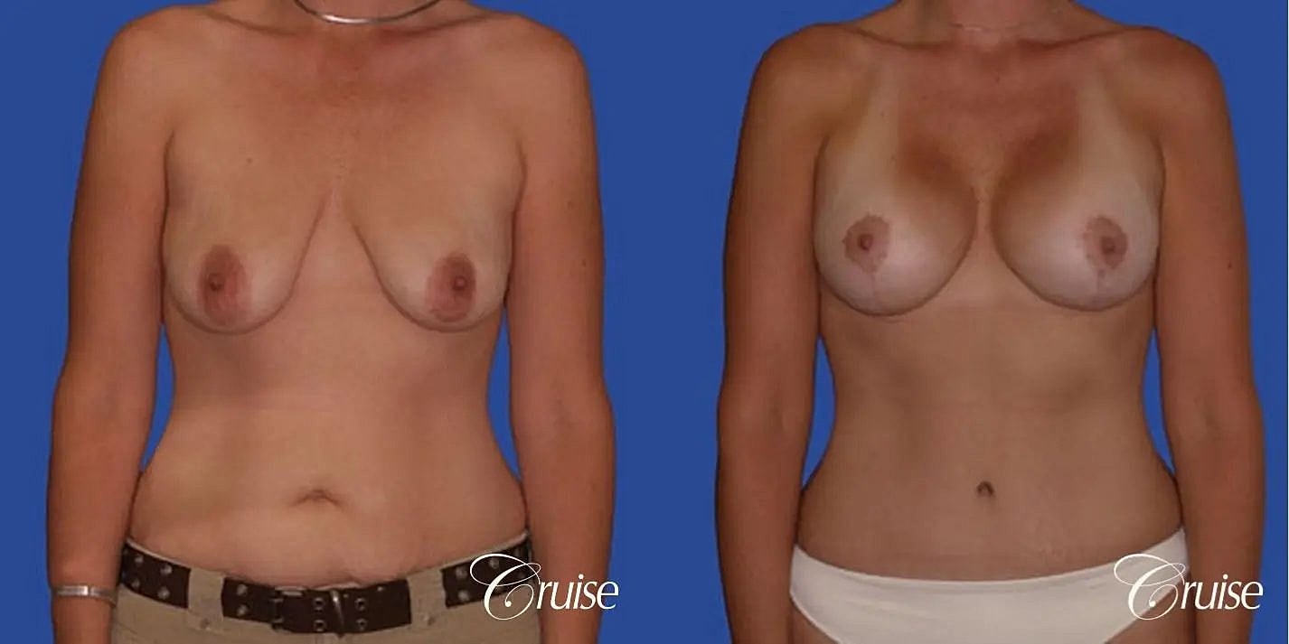 Mommy Makeover Before & After