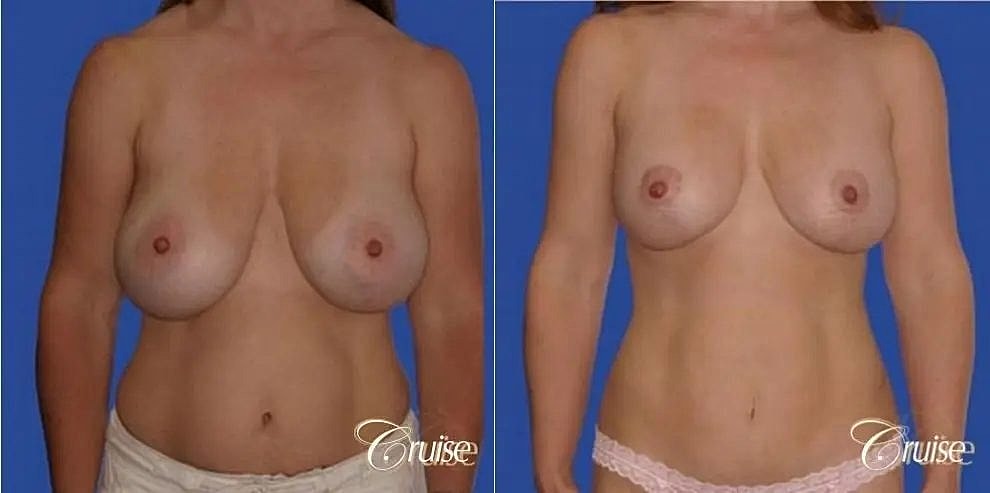 Mommy Makeover Before & After