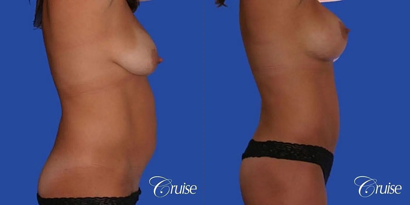Mommy Makeover Before & After