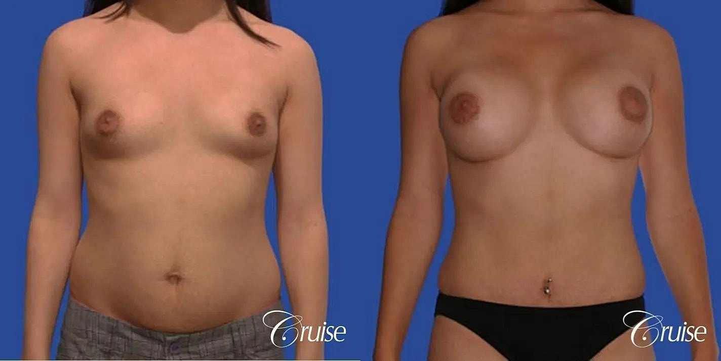 Mommy Makeover Before & After