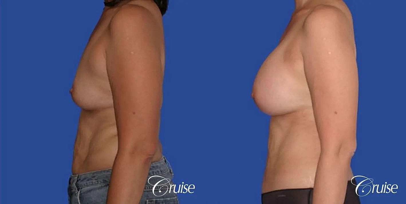 Mommy Makeover Before & After