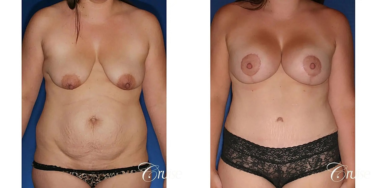 Mommy Makeover Before & After